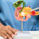 Tumore al pancreas ecco a cosa fare attenzione