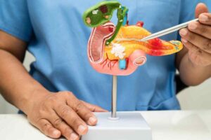 Tumore al pancreas ecco a cosa fare attenzione