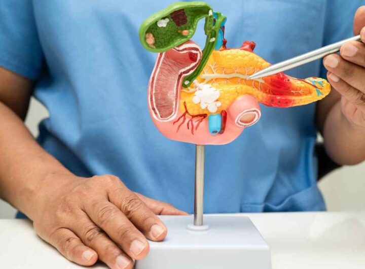 Tumore al pancreas ecco a cosa fare attenzione